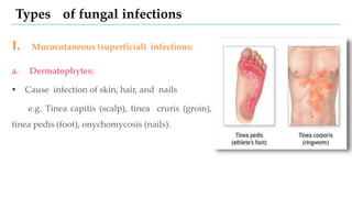 Types of fungal infections
I. Mucocutaneous (superficial) infections:
a. Dermatophytes:
 Cause infection of skin, hair, and nails
e.g. Tinea capitis (scalp), tinea cruris (groin),
tinea pedis (foot), onychomycosis (nails).
 