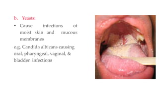 b. Yeasts:
 Cause infections of
moist skin and mucous
membranes
e.g. Candida albicans causing
oral, pharyngeal, vaginal, &
bladder infections
 