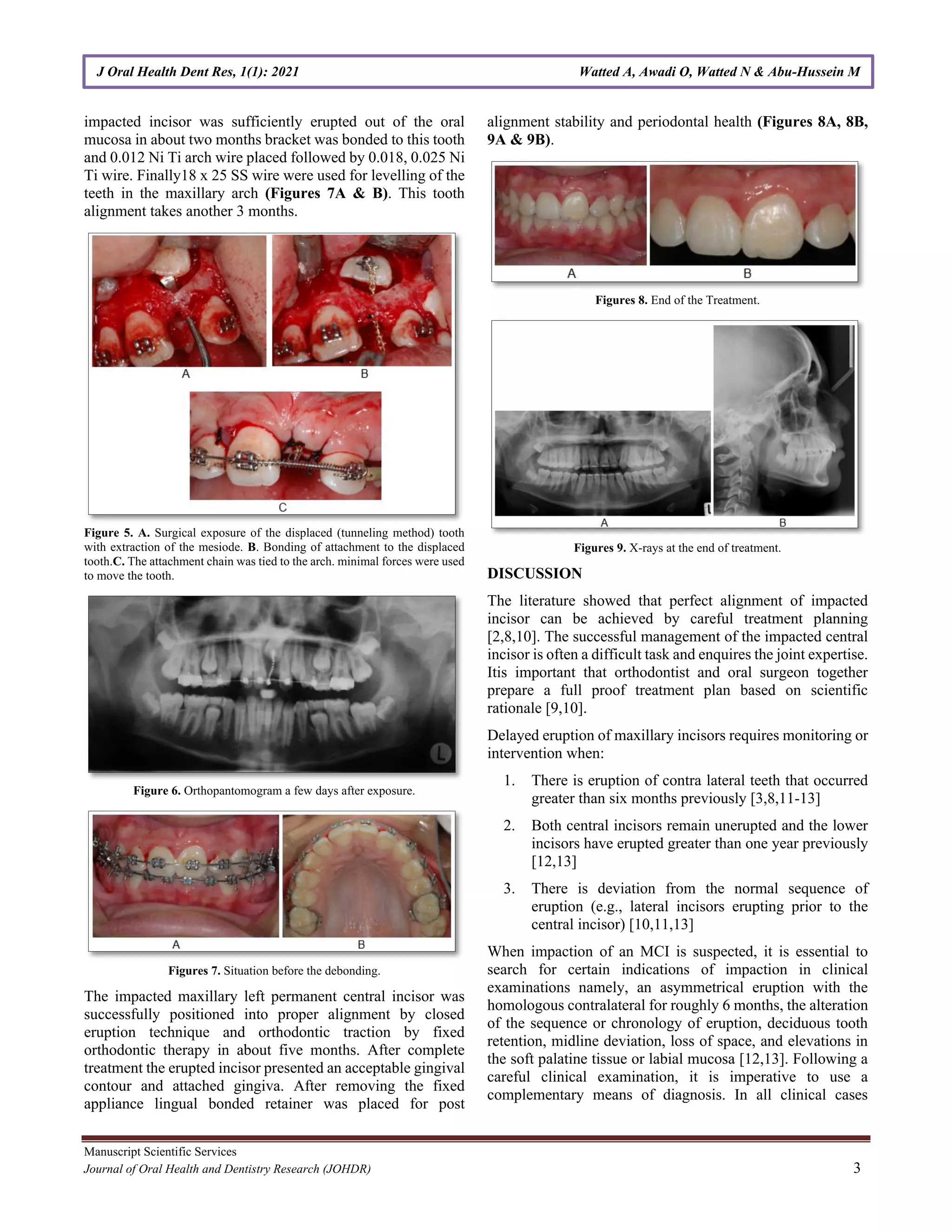 Impacted Maxillary Central Incisors: Surgical Exposure and Orthodontic ...