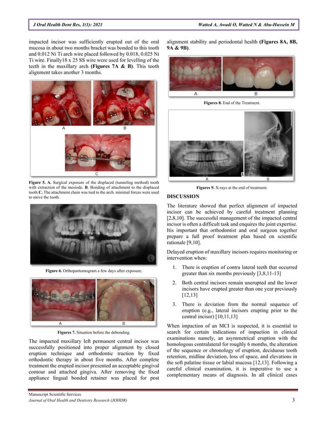 Impacted Maxillary Central Incisors Surgical Exposure and Orthodontic