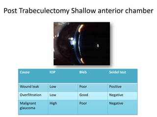 Cause IOP Bleb Seidel test
Wound leak Low Poor Positive
Overfiltration Low Good Negative
Malignant
glaucoma
High Poor Negative
Post Trabeculectomy Shallow anterior chamber
 