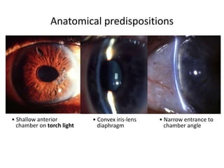 • Convex iris-lens
diaphragm
• Shallow anterior
chamber on torch light
• Narrow entrance to
chamber angle
Anatomical predispositions
 