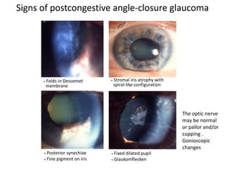 • Folds in Descemet
membrane
• Stromal iris atrophy with
spiral-like configuration
• Posterior synechiae
• Fine pigment on iris
• Fixed dilated pupil
• Glaukomflecken
Signs of postcongestive angle-closure glaucoma
The optic nerve
may be normal
or pallor and/or
cupping .
Gonioscopic
changes
 