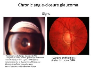 Chronic angle-closure glaucoma
• Cupping and field loss
similar to chronic OAG
• Variable amount of angle closure with PAS
• Easily missed unless routine gonioscopy performed
• Synechial closure for > 1 year –TM becomes
nonfunctional due to degeneration, fibrosis, and
Sclerosis, loss of intertrabecular space
Signs of past post congestive angle closure
Signs
 