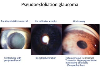 Pseudoexfoliation glaucoma
Pseudoexfoliative material Iris sphincter atrophy Gonioscopy
Central disc with
peripheral band
Heterogeneous (segmental)
Trabecular Hyperpigmentation
may extend anteriorly
(Sampaolesi line)
On retroillumination
 