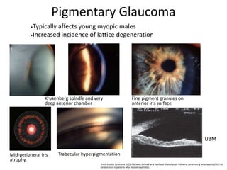 Urets-Zavalia Syndrome (UZS) has been defined as a fixed and dilated pupil following penetrating keratoplasty (PKP) for
keratoconus in patients who receive mydriatics.
•Typically affects young myopic males
•Increased incidence of lattice degeneration
Krukenberg spindle and very
deep anterior chamber
Mid-peripheral iris
atrophy,
Trabecular hyperpigmentation
Fine pigment granules on
anterior iris surface
UBM
Pigmentary Glaucoma
 