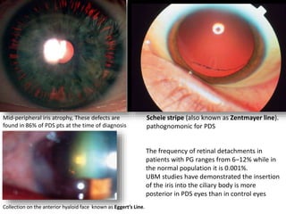 Scheie stripe (also known as Zentmayer line).
pathognomonic for PDS
Collection on the anterior hyaloid face known as Eggert’s Line.
Mid-peripheral iris atrophy, These defects are
found in 86% of PDS pts at the time of diagnosis
The frequency of retinal detachments in
patients with PG ranges from 6–12% while in
the normal population it is 0.001%.
UBM studies have demonstrated the insertion
of the iris into the ciliary body is more
posterior in PDS eyes than in control eyes
 