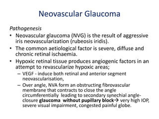 Neovascular Glaucoma
Pathogenesis
• Neovascular glaucoma (NVG) is the result of aggressive
iris neovascularization (rubeosis iridis).
• The common aetiological factor is severe, diffuse and
chronic retinal ischaemia.
• Hypoxic retinal tissue produces angiogenic factors in an
attempt to revascularize hypoxic areas;
– VEGF - induce both retinal and anterior segment
neovascularisation,
– Over angle, NVA form an obstructing fibrovascular
membrane that contracts to close the angle
circumferentially leading to secondary synechial angle-
closure glaucoma without pupillary block very high IOP,
severe visual impairment, congested painful globe.
 