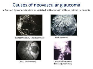 • Caused by rubeosis iridis associated with chronic, diffuse retinal ischaemia
Ischaemic CRVO (most common) PDR (common)
CRAO (uncommon) Carotid obstructive
disease (uncommon)
Causes of neovascular glaucoma
 