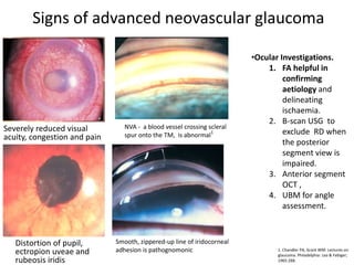 Signs of advanced neovascular glaucoma
•Ocular Investigations.
1. FA helpful in
confirming
aetiology and
delineating
ischaemia.
2. B-scan USG to
exclude RD when
the posterior
segment view is
impaired.
3. Anterior segment
OCT ,
4. UBM for angle
assessment.
1. Chandler PA, Grant WM: Lectures on
glaucoma. Philadelphia: Lea & Febiger;
1965:268.
Severely reduced visual
acuity, congestion and pain
NVA - a blood vessel crossing scleral
spur onto the TM, is abnormal1
Distortion of pupil,
ectropion uveae and
rubeosis iridis
Smooth, zippered-up line of iridocorneal
adhesion is pathognomonic
 