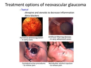 Artificial filtering devices
- in very advanced cases
• Topical
•Atropine and steroids to decrease inflammation
•Beta-blockers
Panretinal photocoagulation
- in early cases
Cyclodestructive procedures
- to relieve pain
Retrobulbar alcohol injection
- to relieve pain
Treatment options of neovascular glaucoma
 
