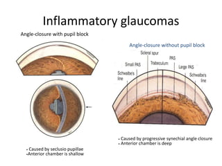 Angle-closure with pupil block
• Caused by seclusio pupillae
•Anterior chamber is shallow
• Caused by progressive synechial angle closure
• Anterior chamber is deep
Angle-closure without pupil block
Inflammatory glaucomas
 