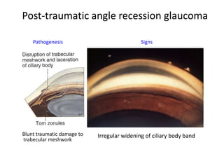 Post-traumatic angle recession glaucoma
Blunt traumatic damage to
trabecular meshwork
Pathogenesis Signs
Irregular widening of ciliary body band
 