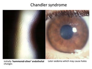 Chandler syndrome
Initially ‘hammered-silver’ endothelial
changes
Later oedema which may cause halos
 