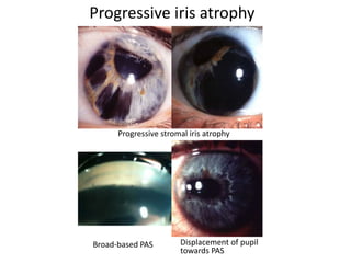Progressive iris atrophy
Progressive stromal iris atrophy
Broad-based PAS Displacement of pupil
towards PAS
 