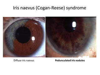 Iris naevus (Cogan-Reese) syndrome
Diffuse iris naevus Pedunculated iris nodules
 