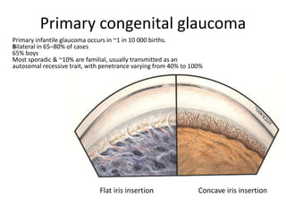 Primary infantile glaucoma occurs in ~1 in 10 000 births.
Bilateral in 65–80% of cases
65% boys
Most sporadic & ~10% are familial, usually transmitted as an
autosomal recessive trait, with penetrance varying from 40% to 100%
Flat iris insertion Concave iris insertion
Primary congenital glaucoma
 