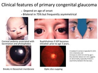Clinical features of primary congenital glaucoma
• Depend on age of onset
• Bilateral in 75% but frequently asymmetrical
Breaks in Descemet membrane
Corneal oedema associated with
lacrimation and photophobia
Buphthalmos if IOP becomes
elevated prior to age 3 years.
Optic disc cupping
A newborn’s cornea is typically 9.5-10.5
mm in diameter and
Increases to 10.0-11.5 mm by age 1.
Any diameter above 12.5 mm suggests
an abnormality, especially if there is
asymmetry between the two eyes.
 