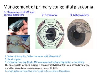 Management of primary congenital glaucoma
2. Goniotomy 3. Trabeculotomy
1. Measurement of IOP and
corneal diameters
4. Trabeculotomy Plus Trabeculectomy with Mitomicin C
5. Shunt Implant
6. Cycloablation using Diode, Microinvasive endo-photocoagulation, cryotherapy.
The success rate for angle surgery is approximately 80% after 1 or 2 procedures, while
the other procedures report a success rate of 33-80%.
7. Amblyopia and refractive error need to be monitored long term
 