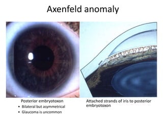 • Bilateral but asymmetrical
• Glaucoma is uncommon
Posterior embryotoxon Attached strands of iris to posterior
embryotoxon
Axenfeld anomaly
 