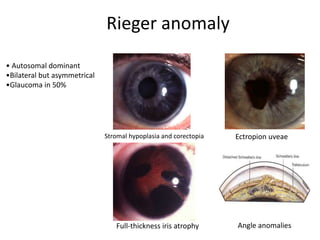 • Autosomal dominant
•Bilateral but asymmetrical
•Glaucoma in 50%
Stromal hypoplasia and corectopia Ectropion uveae
Full-thickness iris atrophy Angle anomalies
Rieger anomaly
 