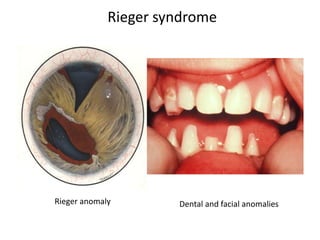 Rieger syndrome
Rieger anomaly Dental and facial anomalies
 