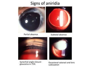 Signs of aniridia
Subtotal absence
Synechial angle-closure
glaucoma in 75%
Occasional cataract and lens
subluxation
Partial absence
 