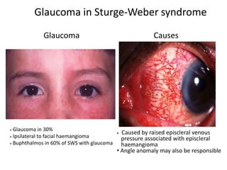 Glaucoma in Sturge-Weber syndrome
• Glaucoma in 30%
• Ipsilateral to facial haemangioma
• Buphthalmos in 60% of SWS with glaucoma
• Caused by raised episcleral venous
pressure associated with episcleral
haemangioma
• Angle anomaly may also be responsible
Glaucoma Causes
 