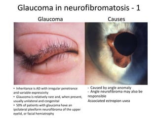 • Caused by angle anomaly
• Angle neurofibroma may also be
responsible
Associated ectropion uvea
Glaucoma Causes
• Inheritance is AD with irregular penetrance
and variable expressivity
• Glaucoma is relatively rare and, when present,
usually unilateral and congenital
• 50% of patients with glaucoma have an
ipsilateral plexiform neurofibroma of the upper
eyelid, or facial hemiatrophy
Glaucoma in neurofibromatosis - 1
 