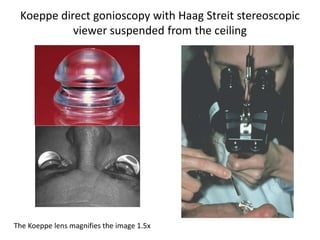 Koeppe direct gonioscopy with Haag Streit stereoscopic
viewer suspended from the ceiling
The Koeppe lens magnifies the image 1.5x
 