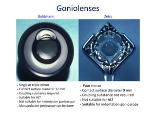 Goldmann Zeiss
• Single or triple mirror
• Contact surface diameter 12 mm
• Coupling substance required
• Suitable for ALT
• Not suitable for indentation gonioscopy
• Manupulation gonioscopy can be done
• Four mirror
• Contact surface diameter 9 mm
• Coupling substance not required
• Not suitable for ALT
• Suitable for indentation gonioscopy
Goniolenses
 