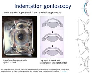 Differentiates ‘appositional’ from ‘synechial’ angle closure
Press Zeiss lens posteriorly
against cornea
Aqueous is forced into
periphery of anterior chamber
The lower the initial pressure, the easier the examination; if the pressure is extremely high, indentation
may be difficult. As the IOP nears 40 mmHg, the ability to move the peripheral iris is lost. (J -2559)
Indentation gonioscopy
 