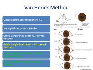 Van Herick Method
Closed angleabsent peripheral AC
Slit angle AC depth = Slit-like
Grade 1 angle AC depth <1⁄4 corneal
thickness
Grade 2 angle AC depth = 1⁄4 corneal
thickness
Grade 3 angle AC depth = 1⁄4 to 1⁄2
corneal thickness
Grade 4 angle AC depth = Corneal
thickness
 