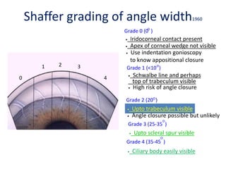 3 2 1
0
4
• Ciliary body easily visible
Grade 4 (35-45 )
Grade 2 (20 )
Grade 1 (<10 )
• Upto trabeculum visible
• Schwalbe line and perhaps
top of trabeculum visible
• High risk of angle closure
• Iridocorneal contact present
• Apex of corneal wedge not visible
• Angle closure possible but unlikely
• Use indentation gonioscopy
to know appositional closure
Grade 0 (0 )
• Upto scleral spur visible
Grade 3 (25-35 )
0
1 2 3
4
Shaffer grading of angle width1960
 