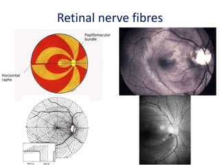 Horizontal
raphe
Retinal nerve fibres
Papillomacular
bundle
Horizontal
raphe
 