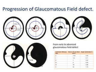 Progression of Glaucomatous Field defect.
From early to advanced
glaucomatous field defect
 