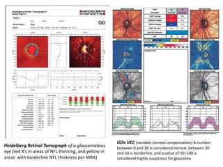GDx VCC (variable corneal compensation) A number
between 0 and 30 is considered normal, between 30
and 50 is borderline, and a value of 50–100 is
considered highly suspicious for glaucoma.
Heidelberg Retinal Tomograph of a glaucomatous
eye (red X’s in areas of NFL thinning, and yellow in
areas with borderline NFL thickness per MRA)
 
