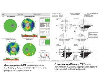 Glaucoma-protocol OCT showing optic nerve
head, peripapillary retinal nerve fibre layer and
ganglion cell complex analysis
Frequency-doubling test (FDT). Large
diameter axon (magnocellular) ganglion cells appear to
be preferentially lost in early glaucoma.
 