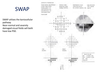 SWAP
SWAP utilizes the koniocellular
pathway
Near-normal and severely
damaged visual fields will both
have low PSD.
 