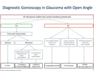 Diagnostic Gonioscopy in Glaucoma with Open Angle
 
