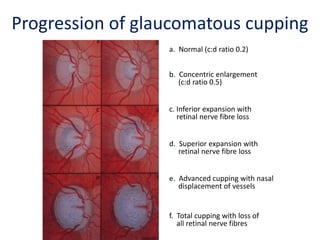 a. Normal (c:d ratio 0.2)
b. Concentric enlargement
(c:d ratio 0.5)
c. Inferior expansion with
retinal nerve fibre loss
e. Advanced cupping with nasal
displacement of vessels
f. Total cupping with loss of
all retinal nerve fibres
d. Superior expansion with
retinal nerve fibre loss
Progression of glaucomatous cupping
 