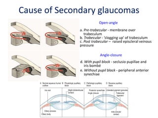 c d
a b
a. Pre-trabecular - membrane over
trabeculum
b. Trabecular - ‘clogging up’ of trabeculum
c. Post trabecular – raised episcleral veinous
pressure
Open-angle
d. With pupil block - seclusio pupillae and
iris bombé
e. Without pupil block - peripheral anterior
synechiae
Angle-closure
Cause of Secondary glaucomas
 