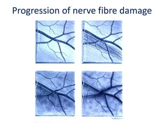 Normal Slit defects
Wedge defects Total atrophy
Progression of nerve fibre damage
 