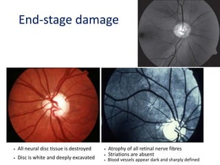 • All neural disc tissue is destroyed
• Disc is white and deeply excavated
• Atrophy of all retinal nerve fibres
• Striations are absent
• Blood vessels appear dark and sharply defined
End-stage damage
 