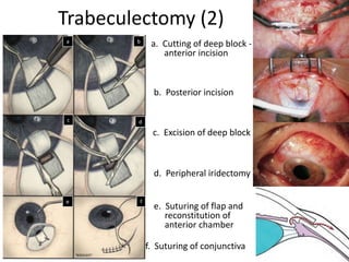 a. Cutting of deep block -
anterior incision
b. Posterior incision
d. Peripheral iridectomy
e. Suturing of flap and
reconstitution of
anterior chamber
f. Suturing of conjunctiva
c. Excision of deep block
f
d
b
a
c
e
Trabeculectomy (2)
 