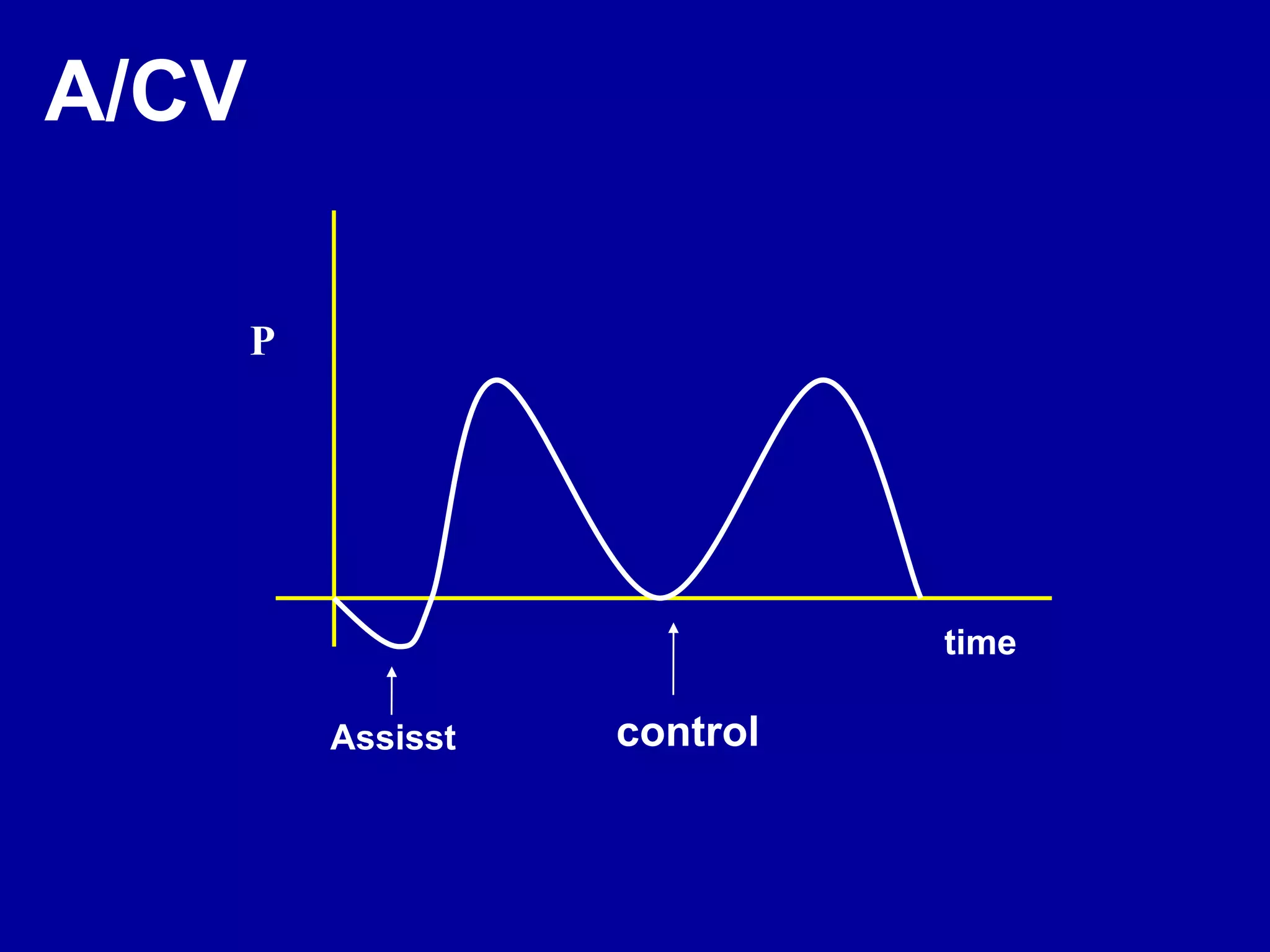 P
time
Assisst control
A/CV
 