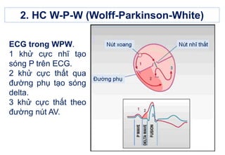 2. HC W-P-W (Wolff-Parkinson-White)
ECG trong WPW.
1 khử cực nhĩ tạo
sóng P trên ECG.
2 khử cực thất qua
đường phụ tạo sóng
delta.
3 khử cực thất theo
đường nút AV.
 