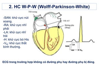 2. HC W-P-W (Wolff-Parkinson-White)
ECG trong trường hợp không có đường phụ hay đường phụ bị đóng.
-SAN: khử cực nút
xoang.
-RA: khử cực nhĩ
phải
-LA: khử cực nhĩ
trái
-H: khử cực bó His
-VN: khử cực thất
bình thường.
 