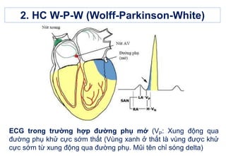 2. HC W-P-W (Wolff-Parkinson-White)
ECG trong trường hợp đường phụ mở (VP: Xung động qua
đường phụ khử cực sớm thất (Vùng xanh ở thất là vùng được khử
cực sớm từ xung động qua đường phụ. Mũi tên chỉ sóng delta)
 