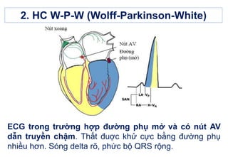2. HC W-P-W (Wolff-Parkinson-White)
ECG trong trường hợp đường phụ mở và có nút AV
dẫn truyền chậm. Thất đuợc khử cực bằng đường phụ
nhiều hơn. Sóng delta rõ, phức bộ QRS rộng.
 